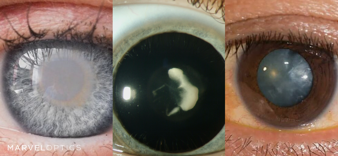 types of cataracts