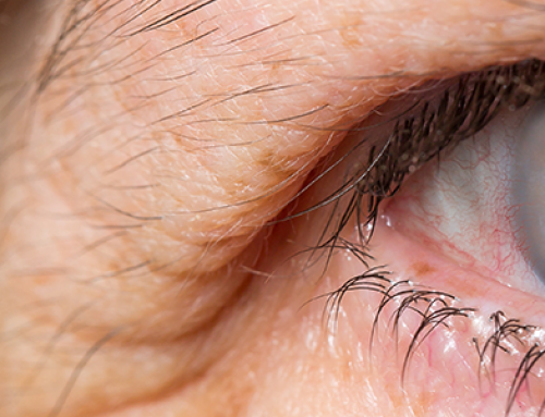 Do Prescription Safety Glasses Prevent Cataract Development?